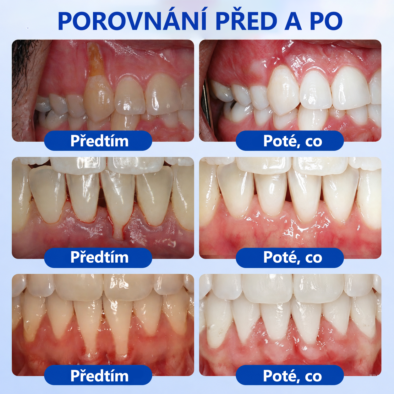 🦷🦷 𝑮𝒍𝒊𝒎𝒎𝒆𝒓𝒍𝒚® 𝑮𝒖𝒎𝑹𝒆𝒗𝒊𝒗𝒆 𝑷𝒂𝒓𝒐𝒅𝒐𝒏𝒕𝒂́𝒍𝒏𝒊́ 𝑹𝒆𝒈𝒆𝒏𝒆𝒓𝒂𝒄̌𝒏𝒊́ 𝑮𝒆𝒍
